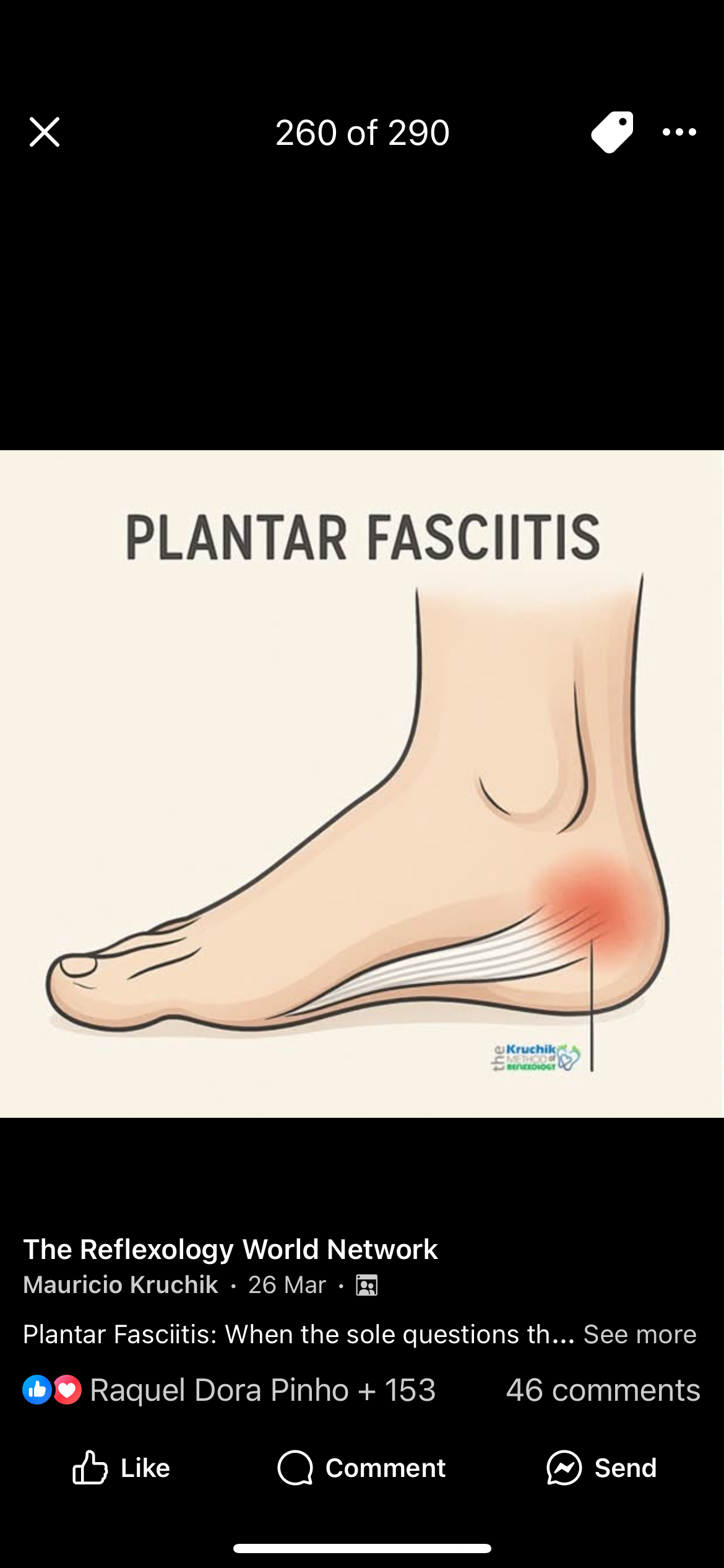 Reflexology for pain relief